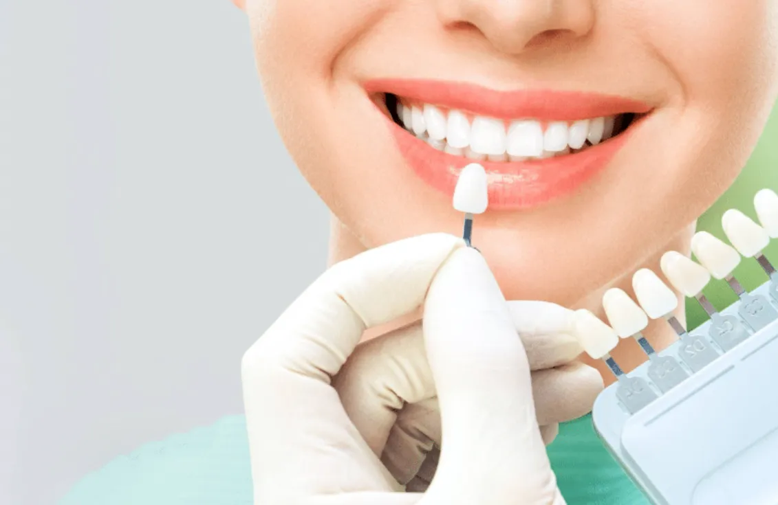 Top 6 Questions to Ask Before a London Veneer Treatment, Answered by a London Dentist